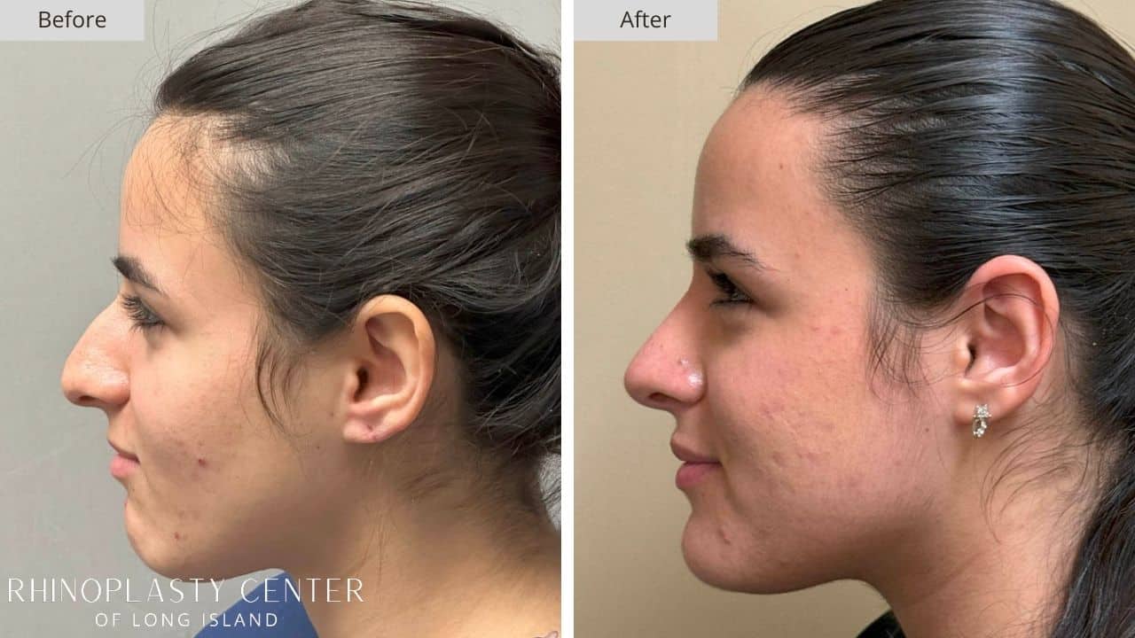 Rhinoplasty Long Island Before and After Photo 10a