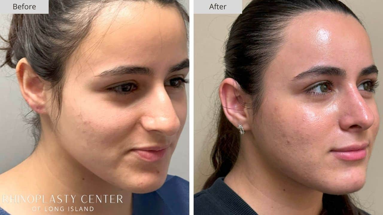 Rhinoplasty Long Island Before and After Photo 10b