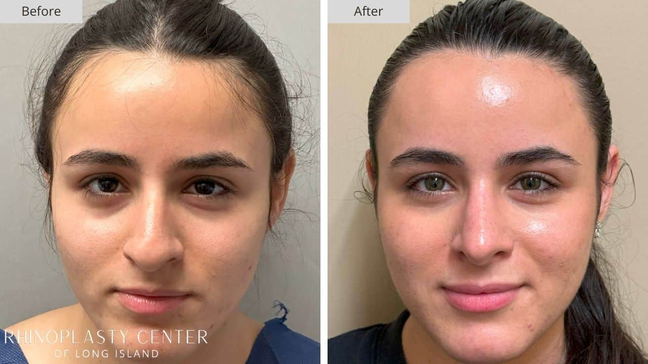 Rhinoplasty Long Island Before and After Photo 10c