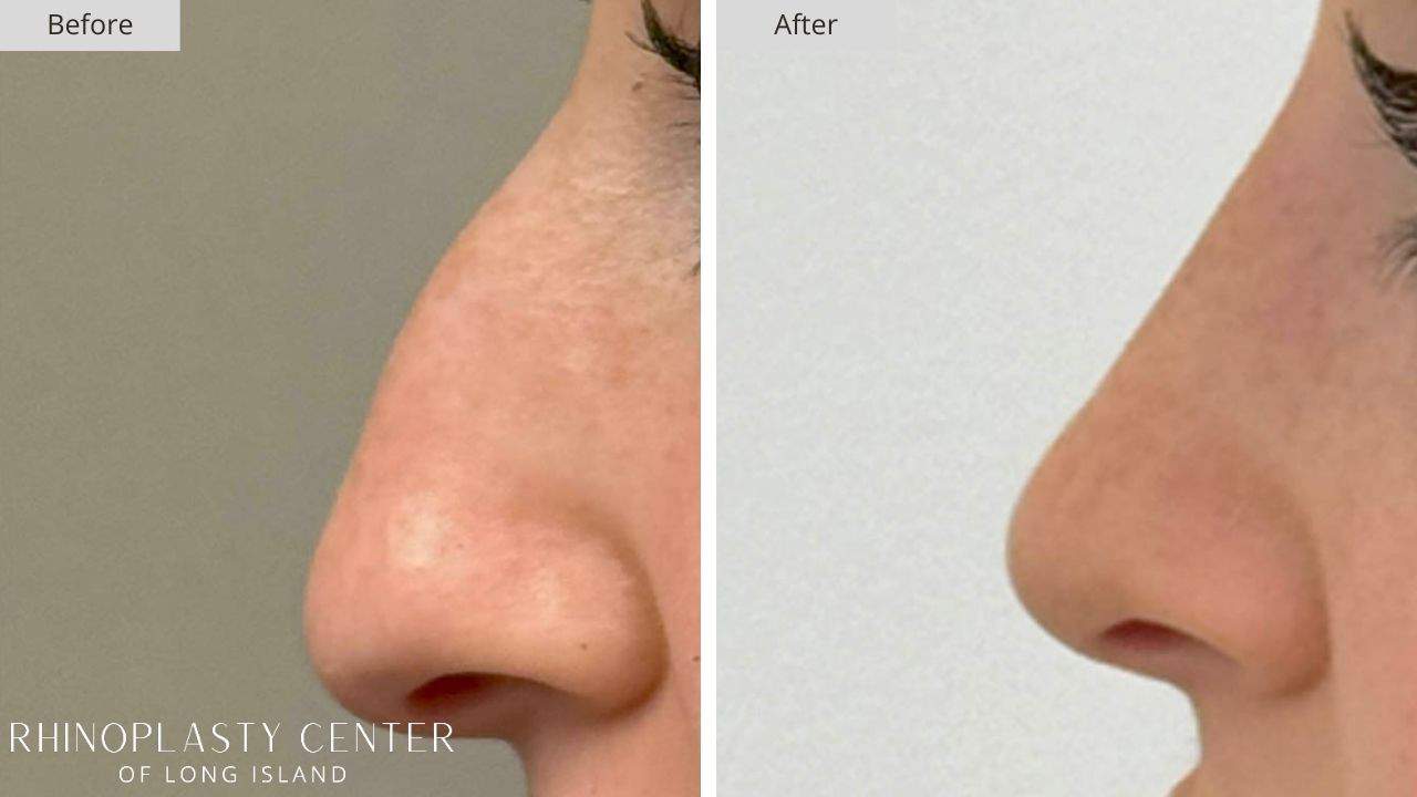 Rhinoplasty Long Island Before and After Photo 11a