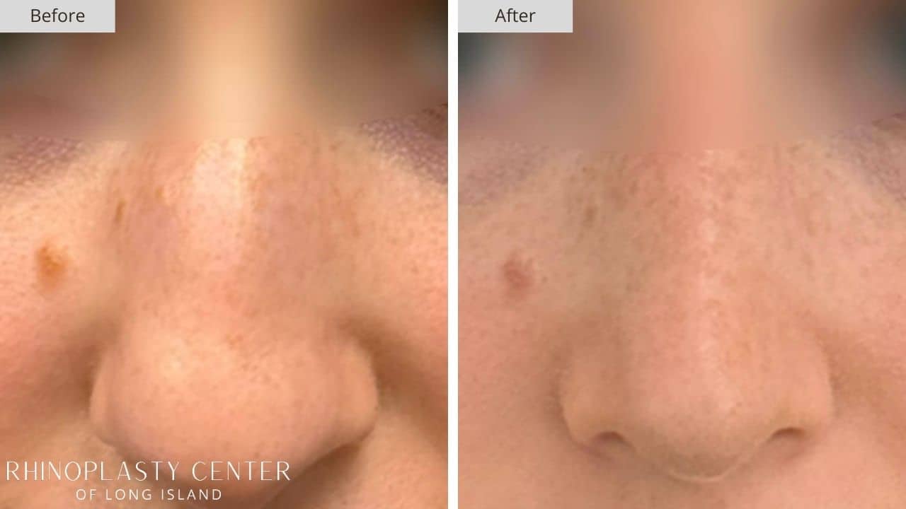 Rhinoplasty Long Island Before and After Photo 11b