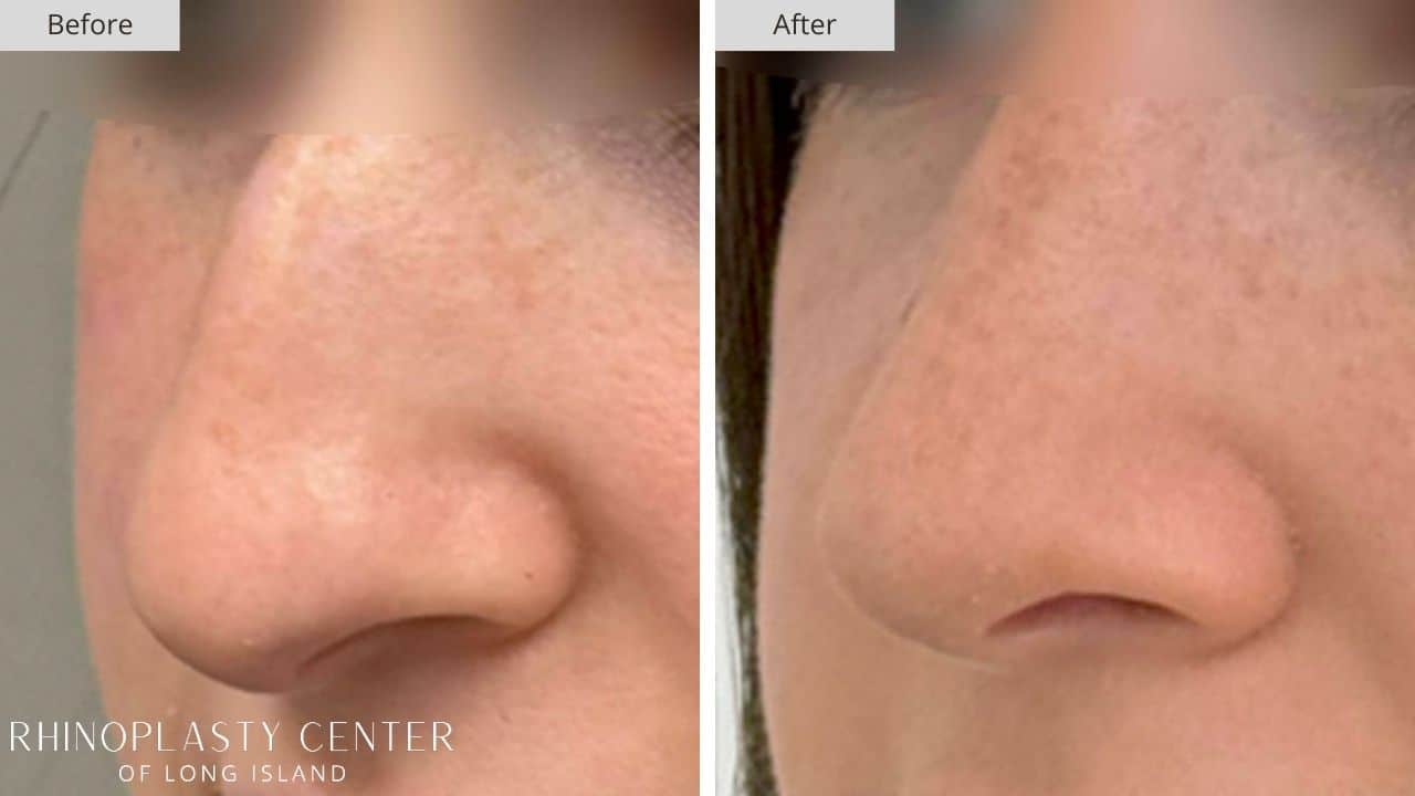 Rhinoplasty Long Island Before and After Photo 11c