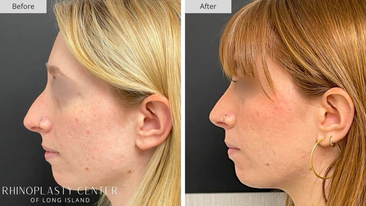 Rhinoplasty Long Island Before and After Photo 14a
