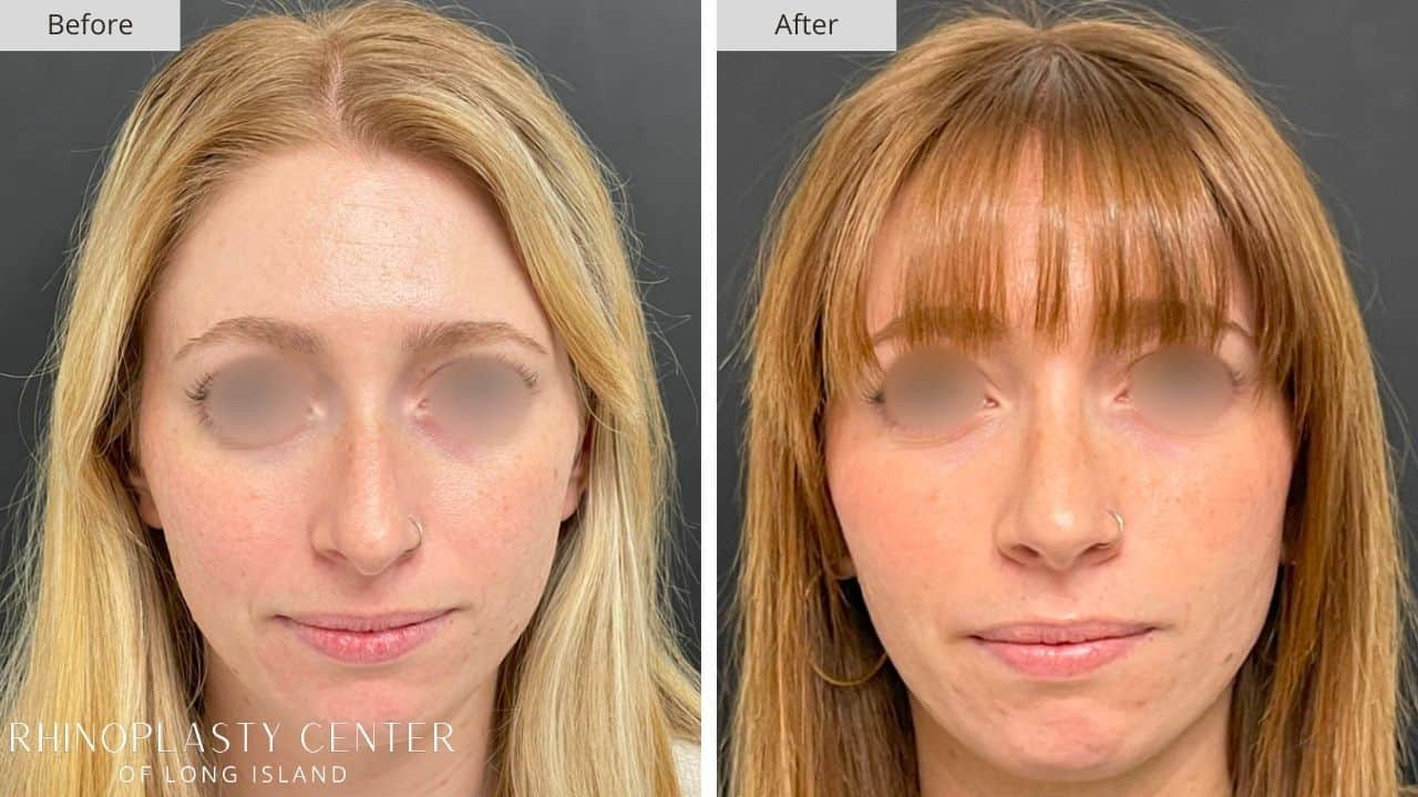 Rhinoplasty Long Island Before and After Photo 14b