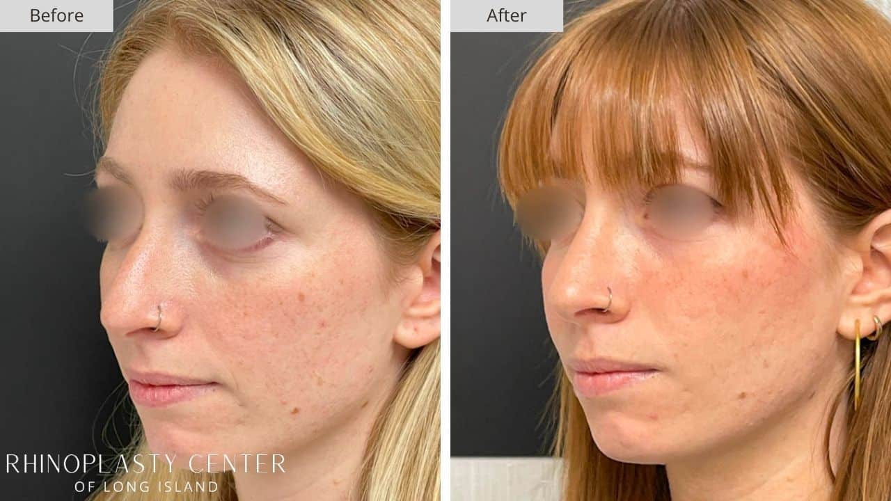 Rhinoplasty Long Island Before and After Photo 14c