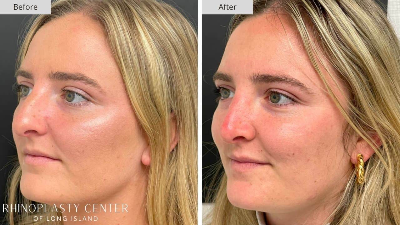 Rhinoplasty Long Island Before and After Photo 15a