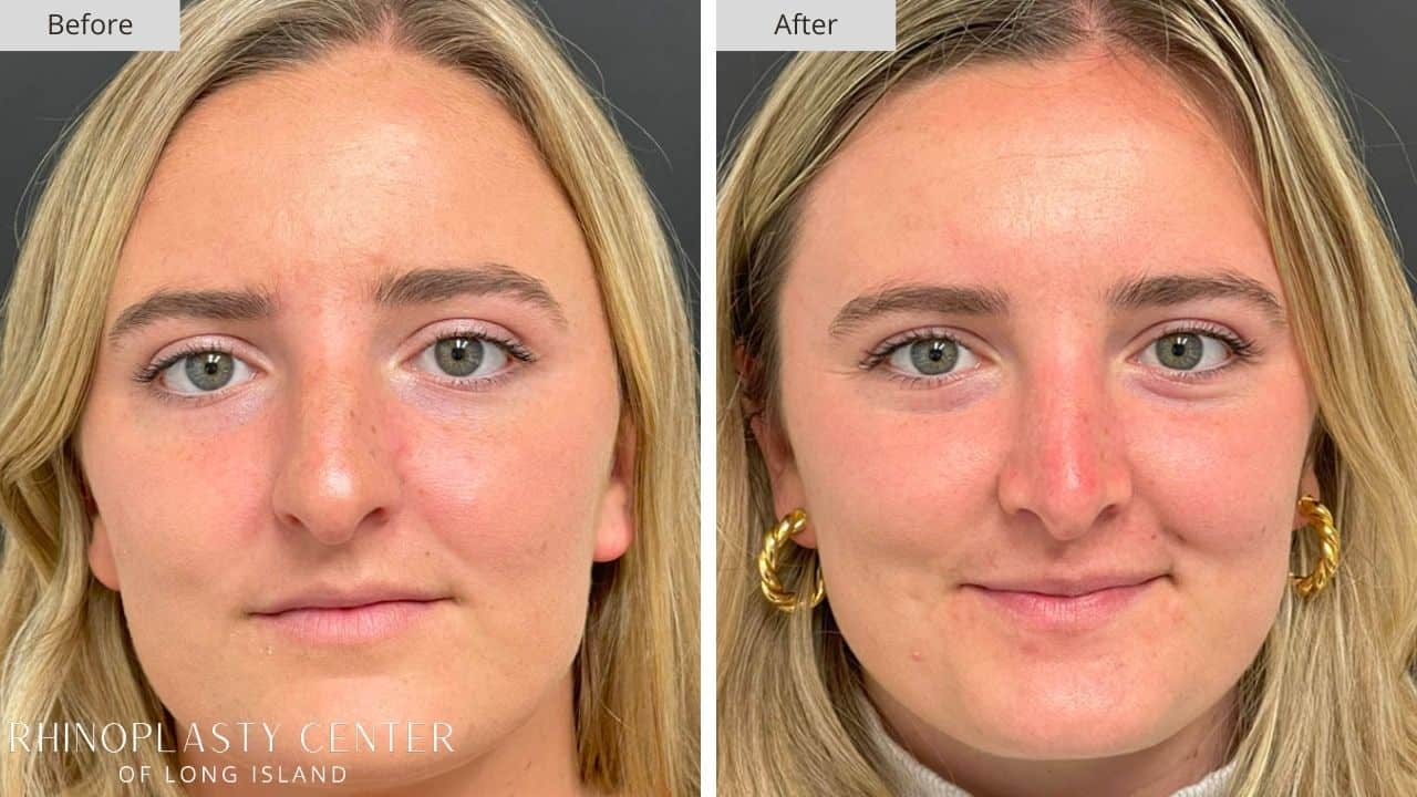 Rhinoplasty Long Island Before and After Photo 15b