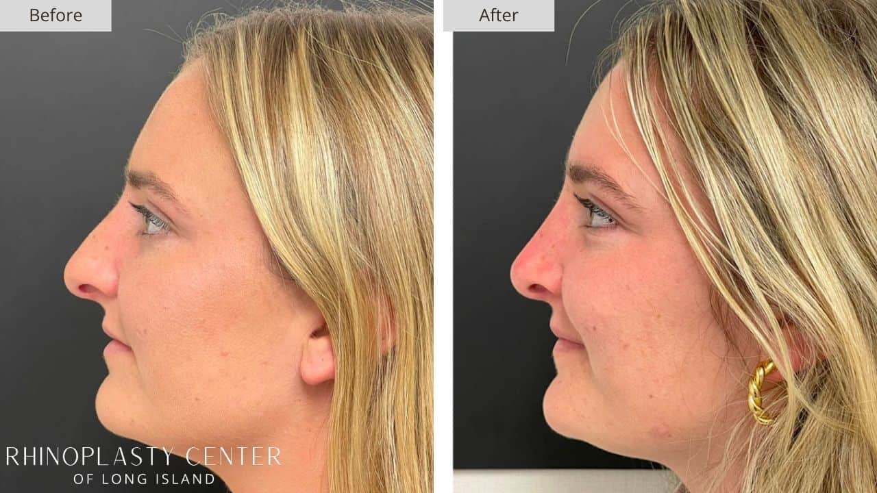 Rhinoplasty Long Island Before and After Photo 15c