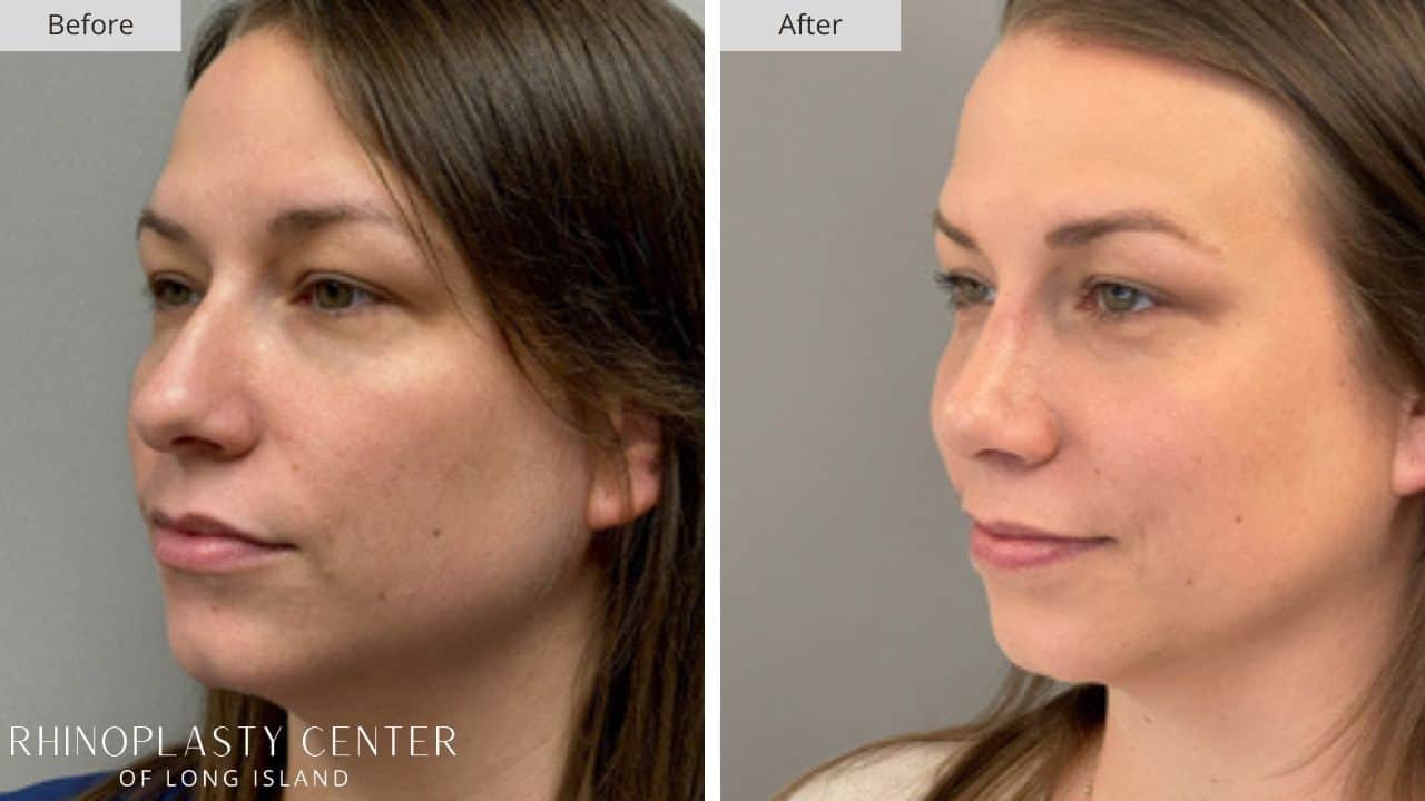 Rhinoplasty Long Island Before and After Photo 16a