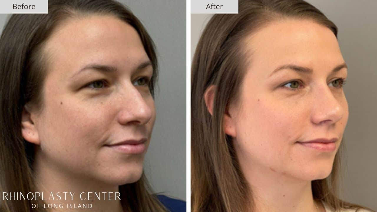 Rhinoplasty Long Island Before and After Photo 16b
