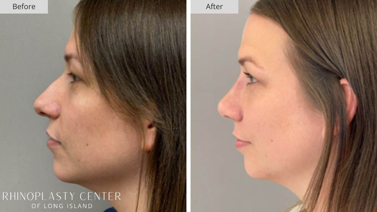 Rhinoplasty Long Island Before and After Photo 16c