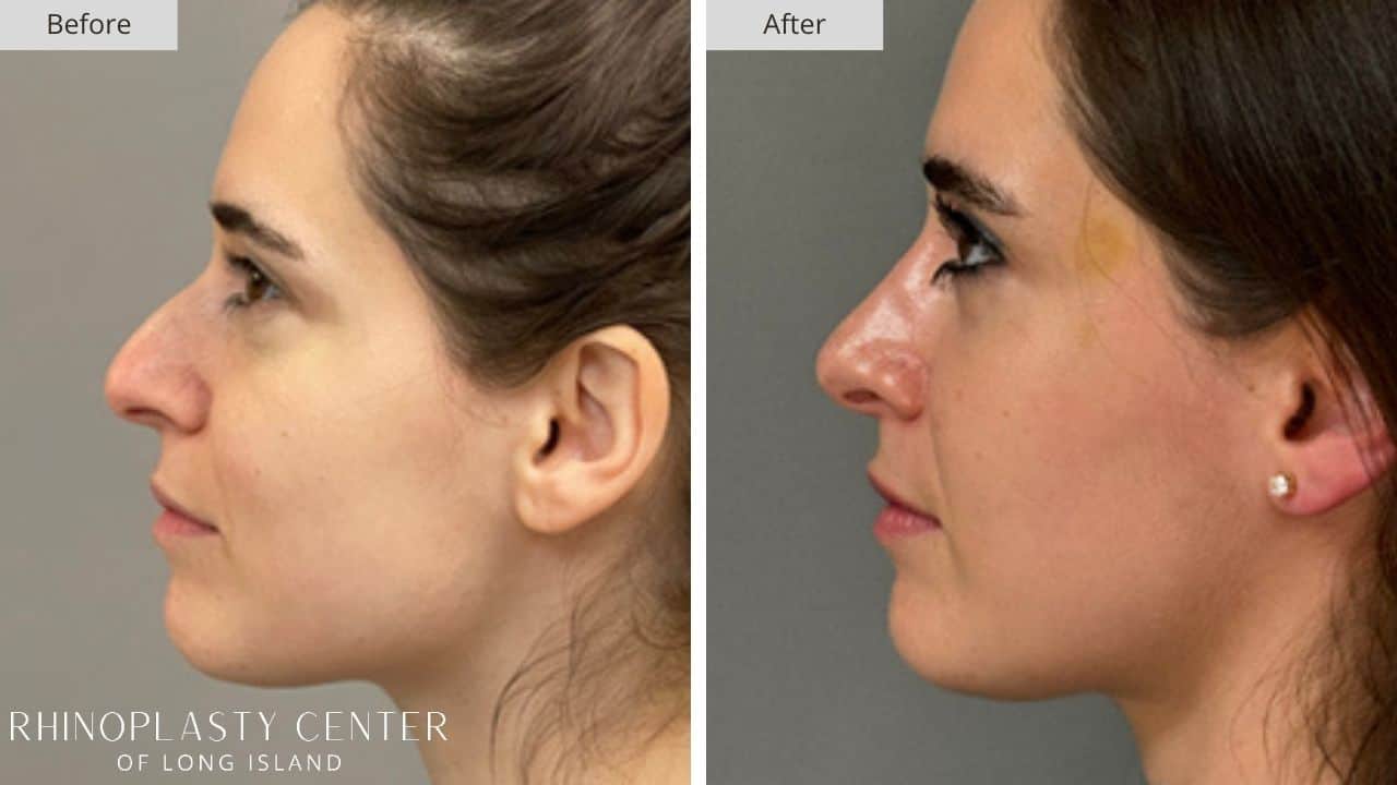 Rhinoplasty Long Island Before and After Photo 17a