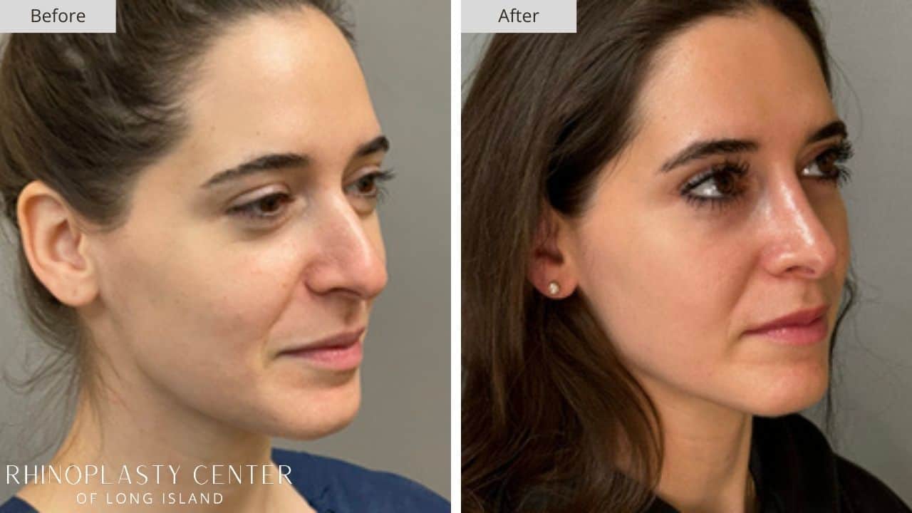 Rhinoplasty Long Island Before and After Photo 17b