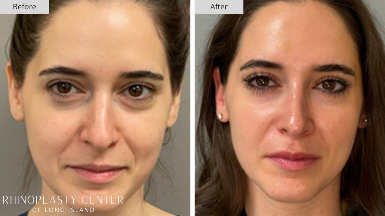 Rhinoplasty Long Island Before and After Photo 17c