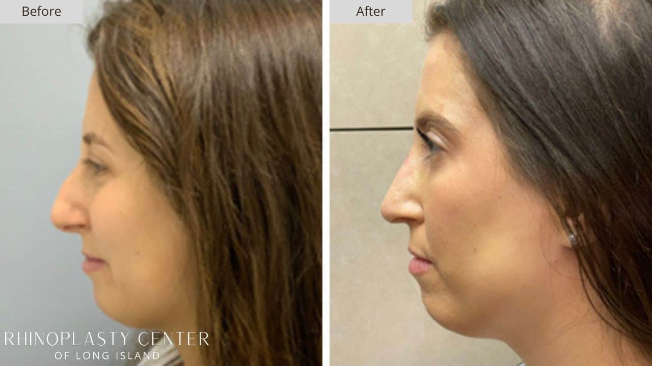Rhinoplasty Long Island Before and After Photo 18a