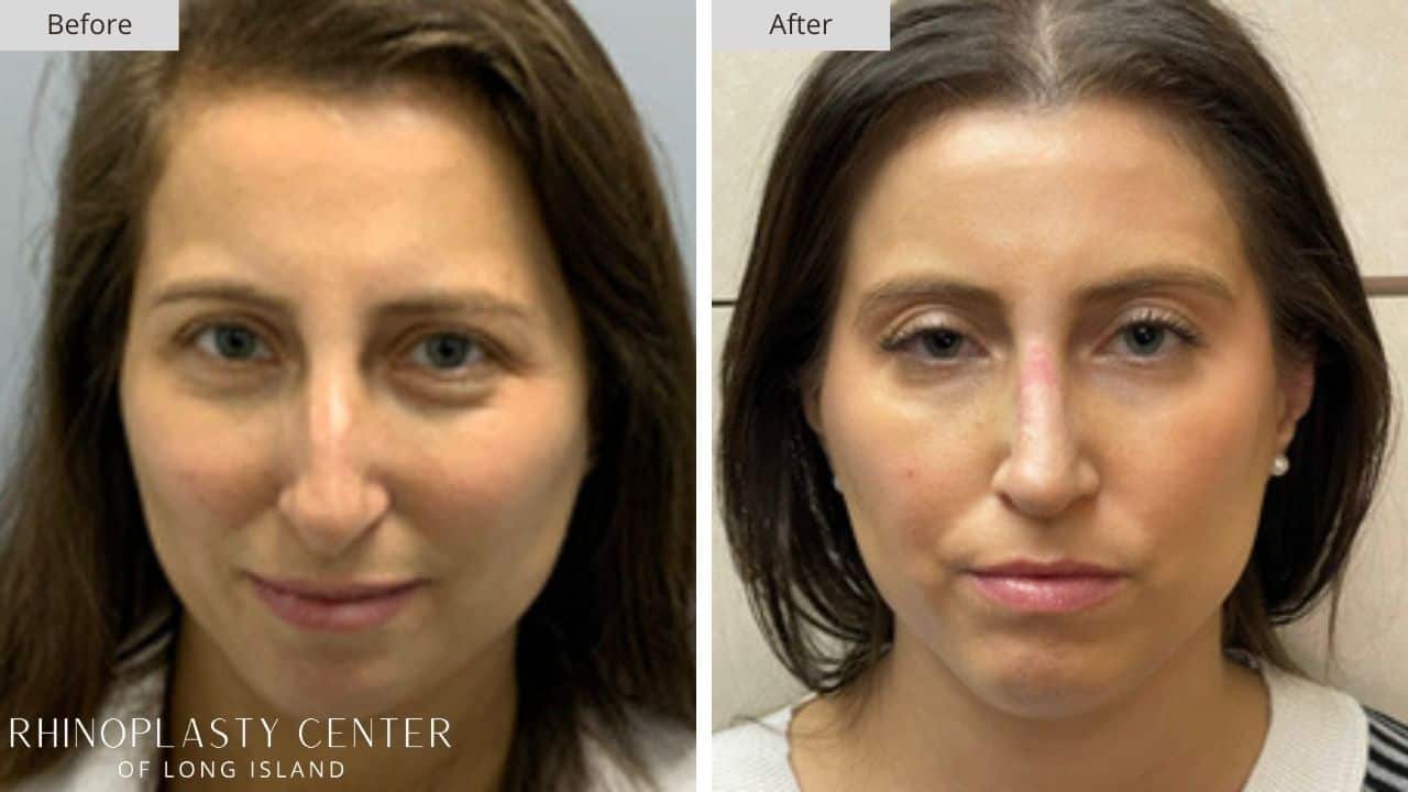 Rhinoplasty Long Island Before and After Photo 18b