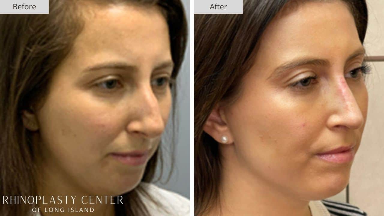 Rhinoplasty Long Island Before and After Photo 18c