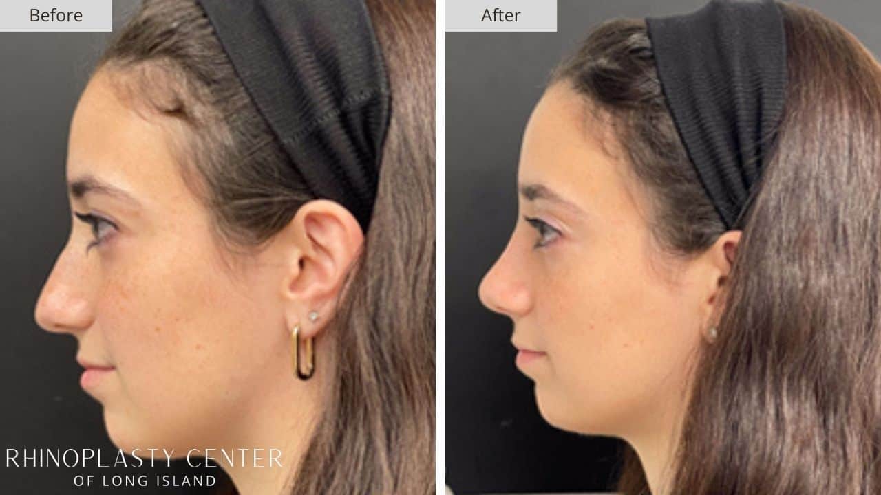 Rhinoplasty Long Island Before and After Photo 19a
