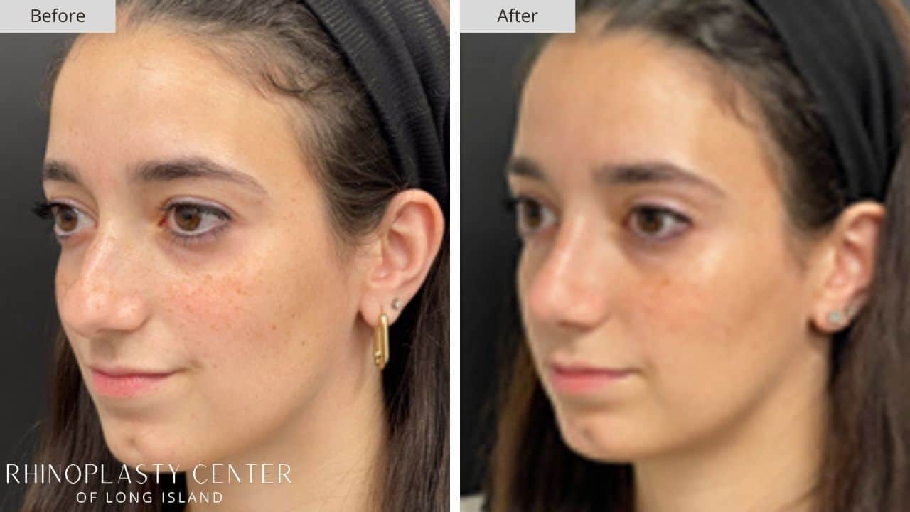 Rhinoplasty Long Island Before and After Photo 19b