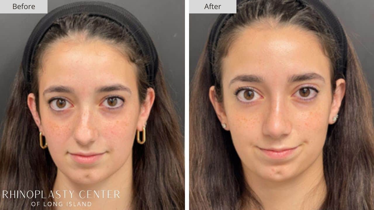 Rhinoplasty Long Island Before and After Photo 19c