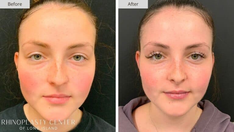 Rhinoplasty Long Island Before and After Photo 1b