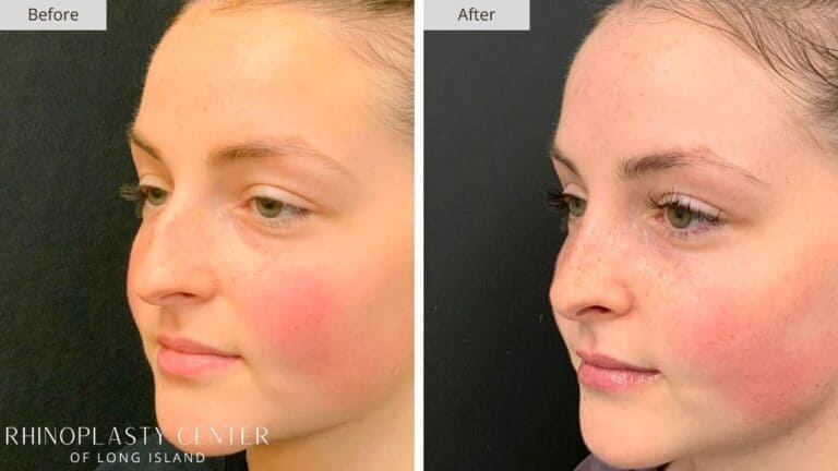 Rhinoplasty Long Island Before and After Photo 1c