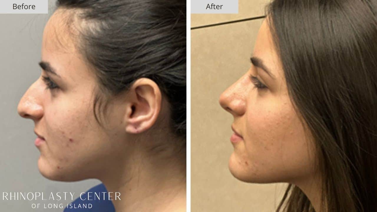 Rhinoplasty Long Island Before and After Photo 20a