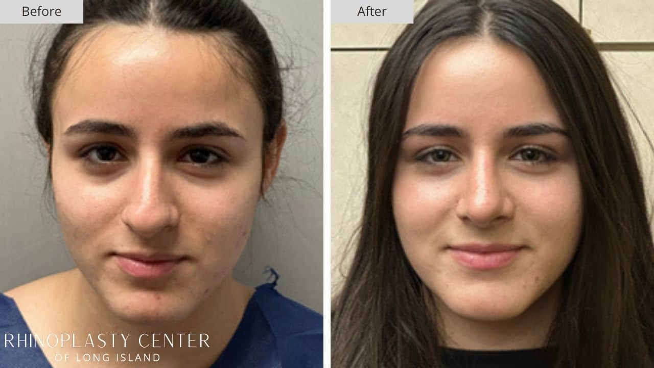 Rhinoplasty Long Island Before and After Photo 20b