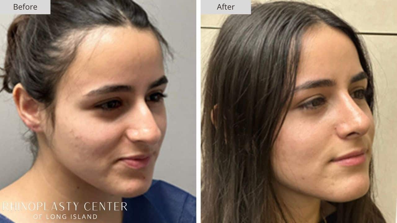 Rhinoplasty Long Island Before and After Photo 20c