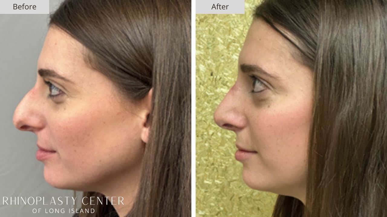 Rhinoplasty Long Island Before and After Photo 21a