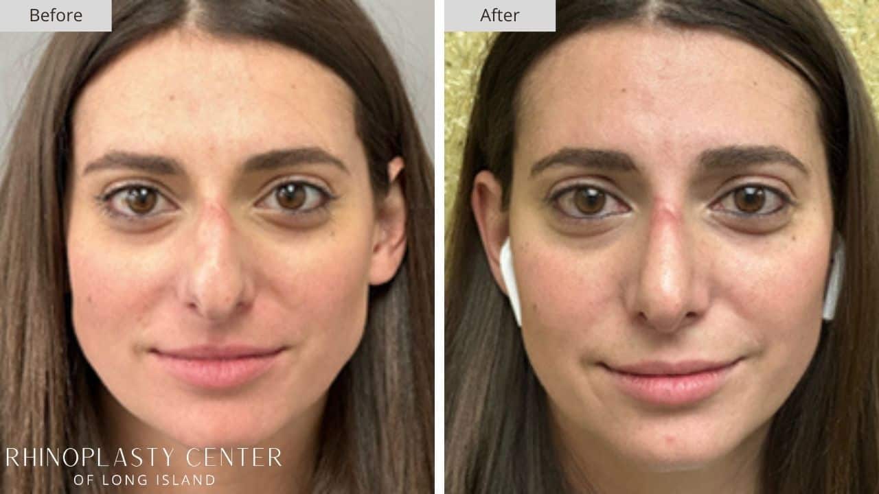 Rhinoplasty Long Island Before and After Photo 21b