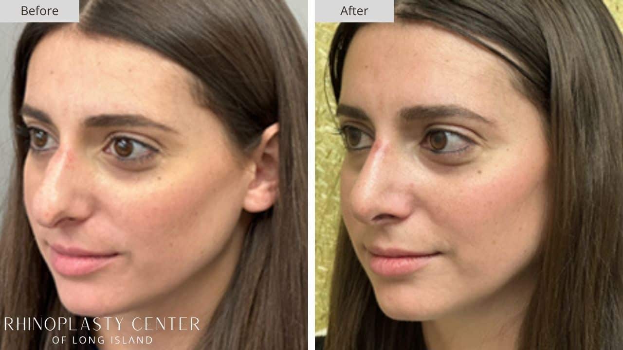 Rhinoplasty Long Island Before and After Photo 21c