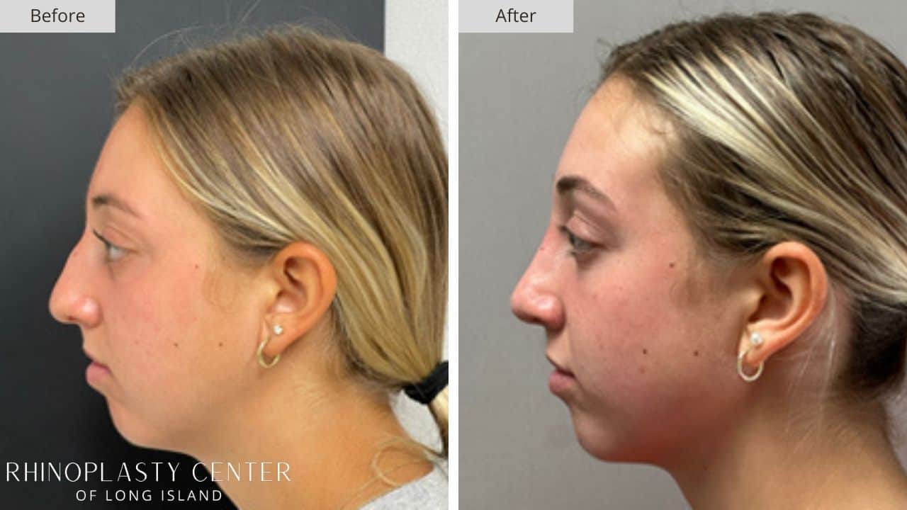 Rhinoplasty Long Island Before and After Photo 23a