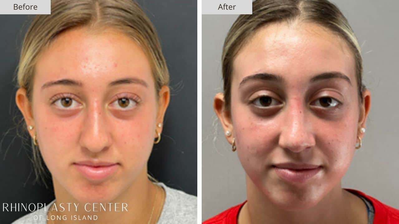 Rhinoplasty Long Island Before and After Photo 23b