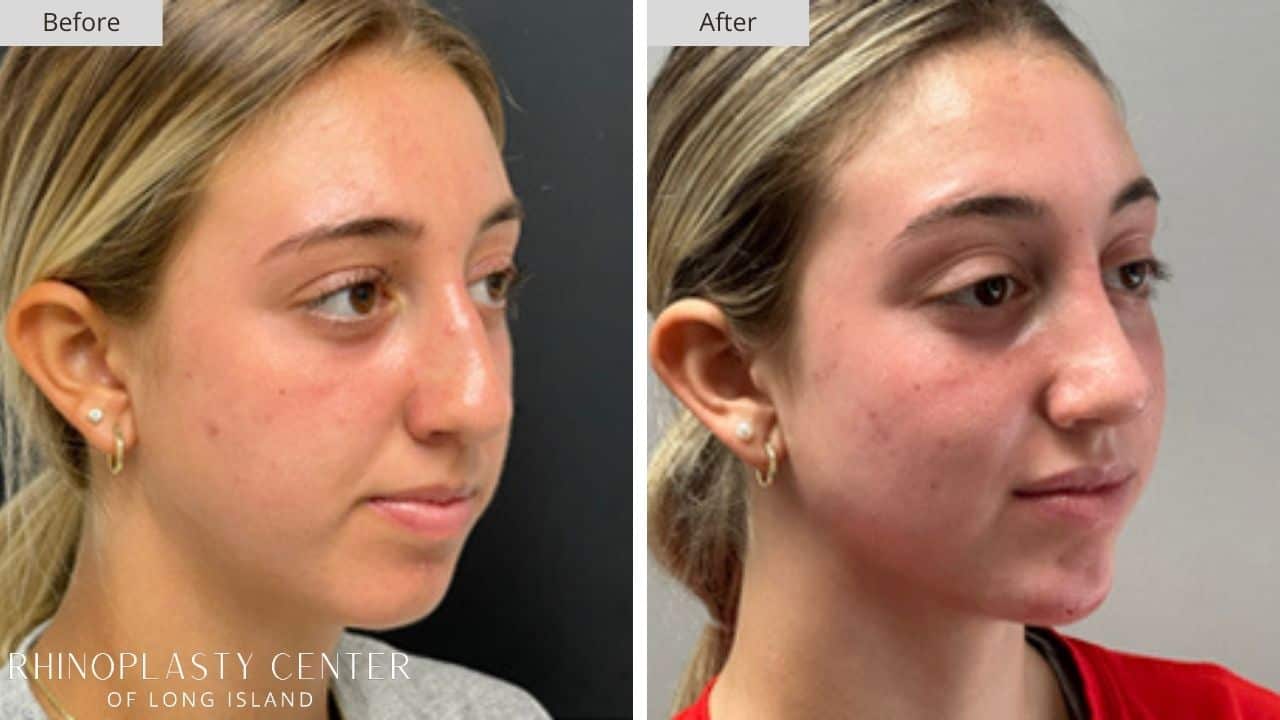 Rhinoplasty Long Island Before and After Photo 23c