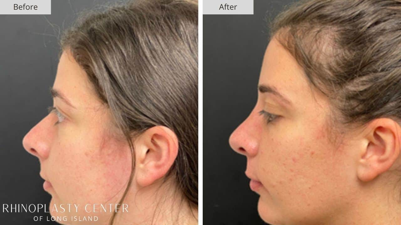Rhinoplasty Long Island Before and After Photo 24a
