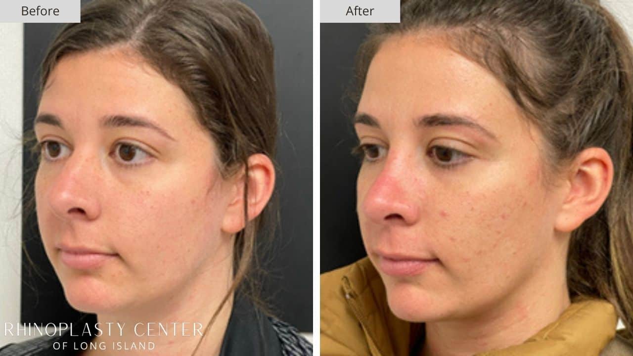 Rhinoplasty Long Island Before and After Photo 24b