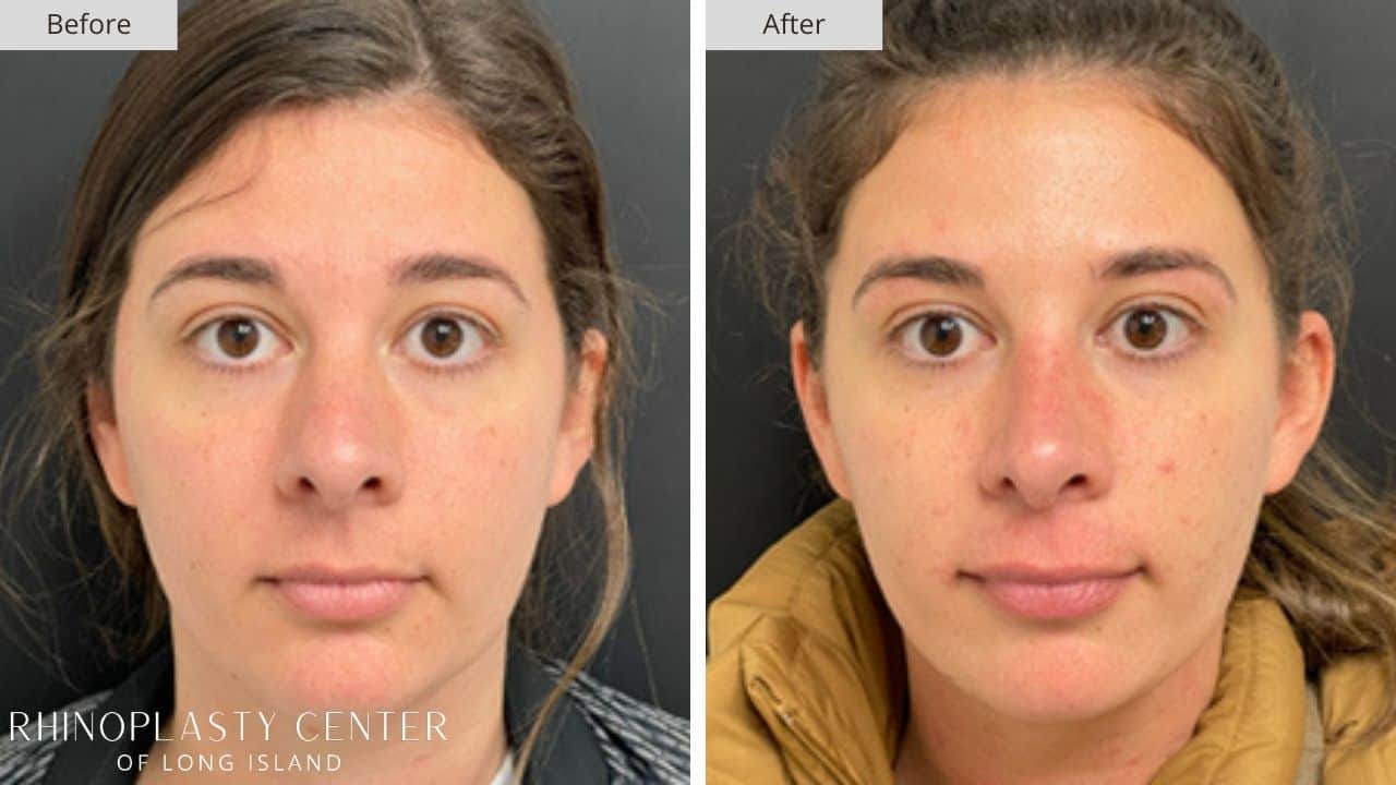 Rhinoplasty Long Island Before and After Photo 24c