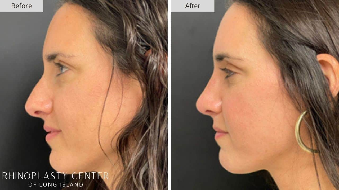 Rhinoplasty Long Island Before and After Photo 25a