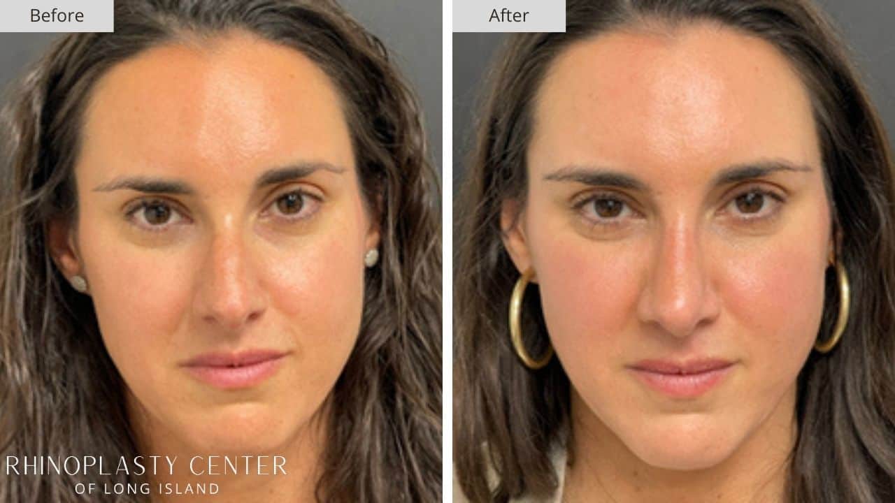 Rhinoplasty Long Island Before and After Photo 25b