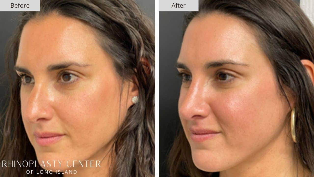 Rhinoplasty Long Island Before and After Photo 25c