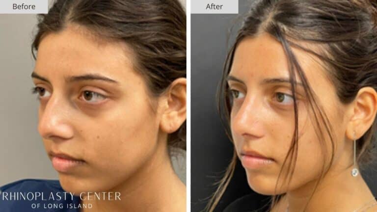 Rhinoplasty Long Island Before and After Photo 27b