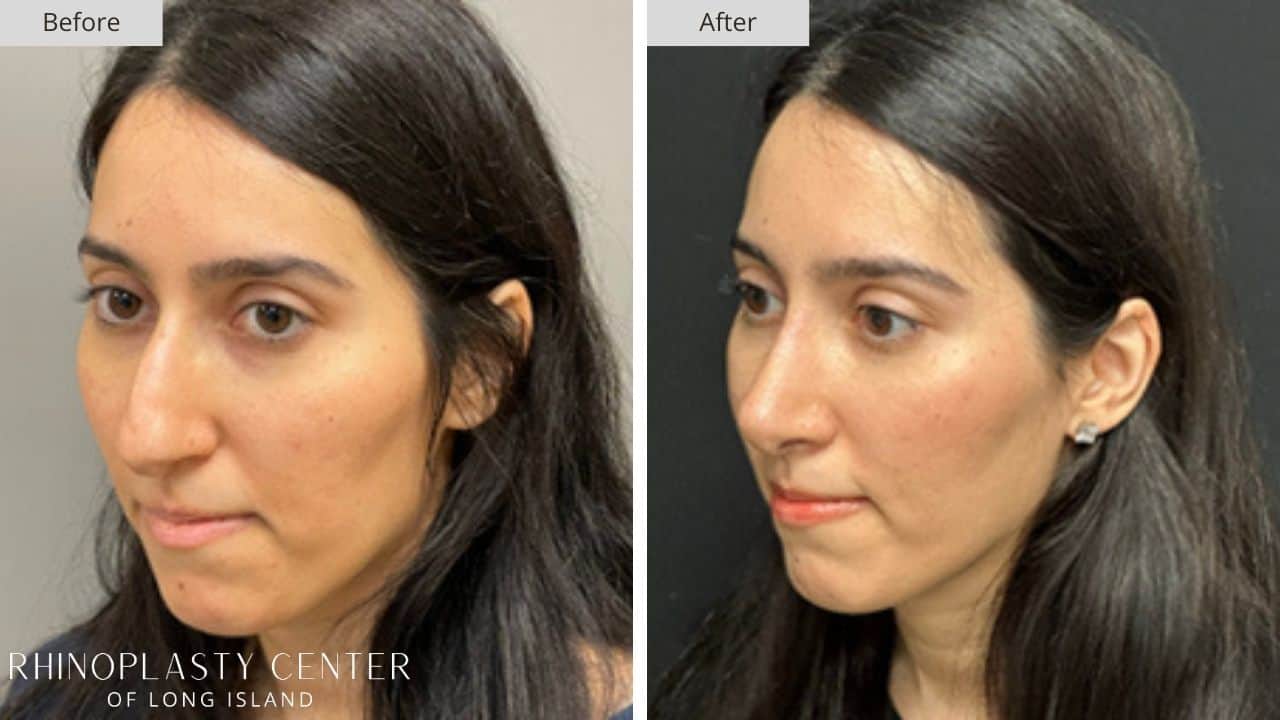 Rhinoplasty Long Island Before and After Photo 29a