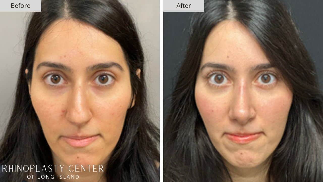 Rhinoplasty Long Island Before and After Photo 29b