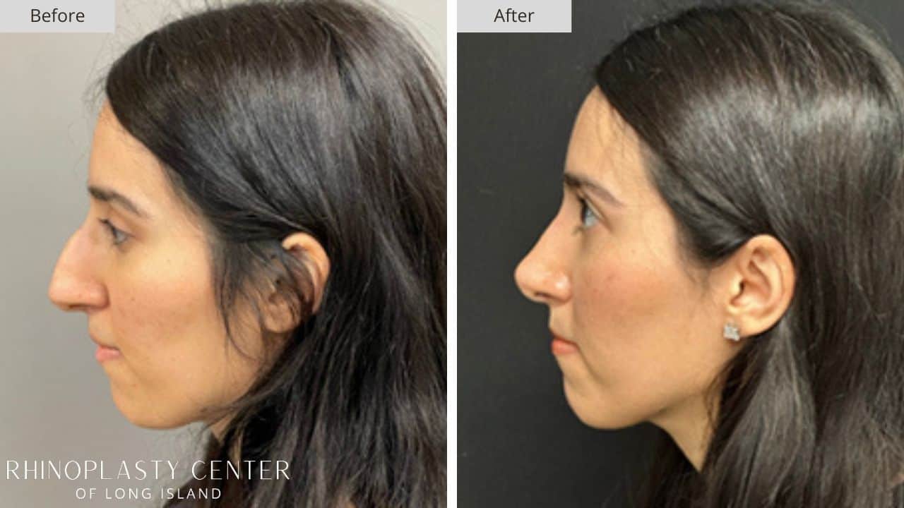 Rhinoplasty Long Island Before and After Photo 29c