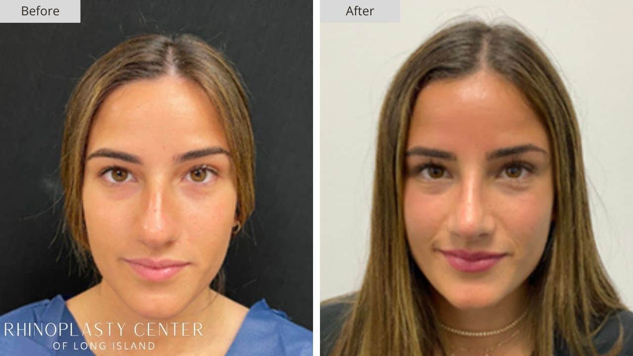 Rhinoplasty Long Island Before and After Photo 30a
