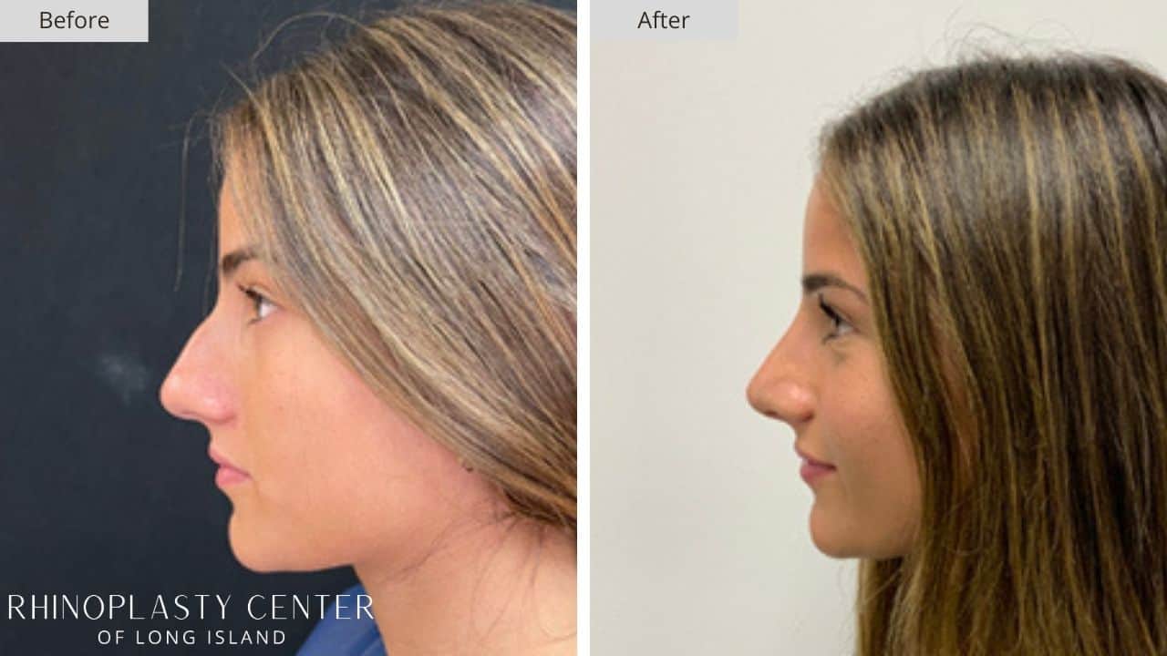 Rhinoplasty Long Island Before and After Photo 30b