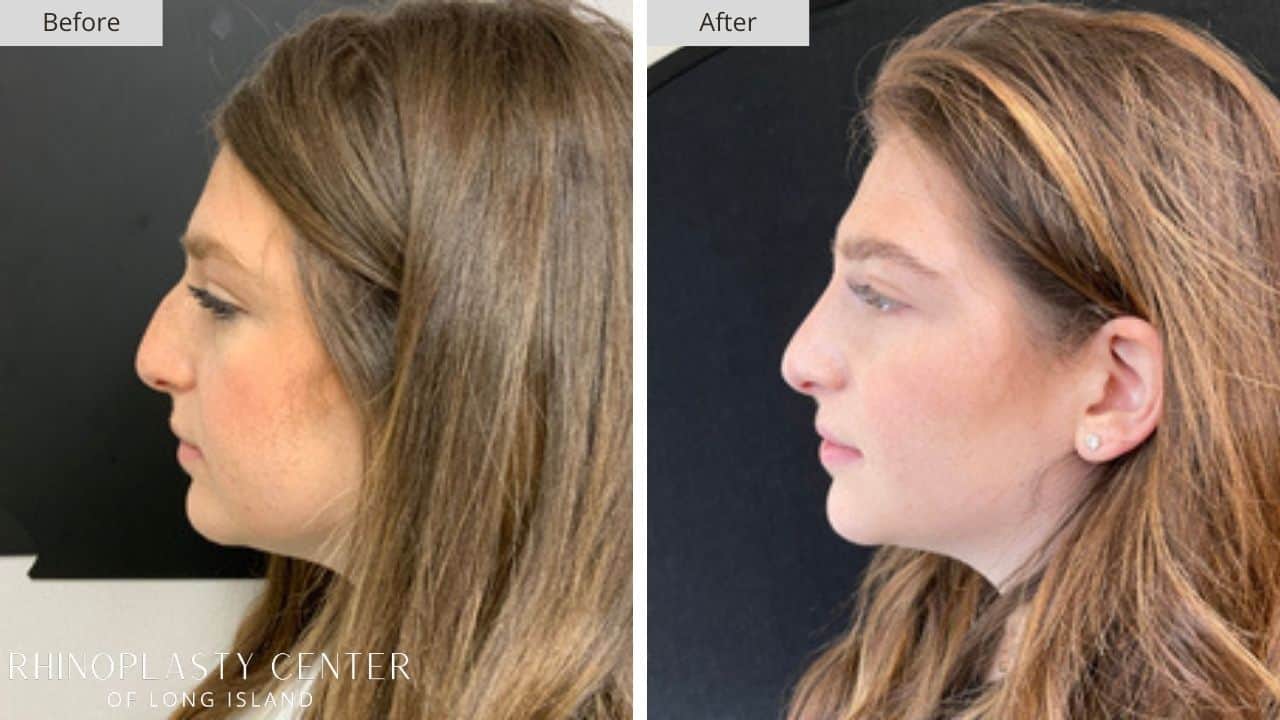 Rhinoplasty Long Island Before and After Photo 31a