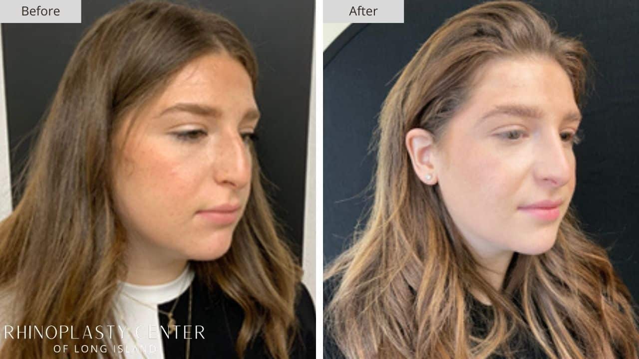 Rhinoplasty Long Island Before and After Photo 31b
