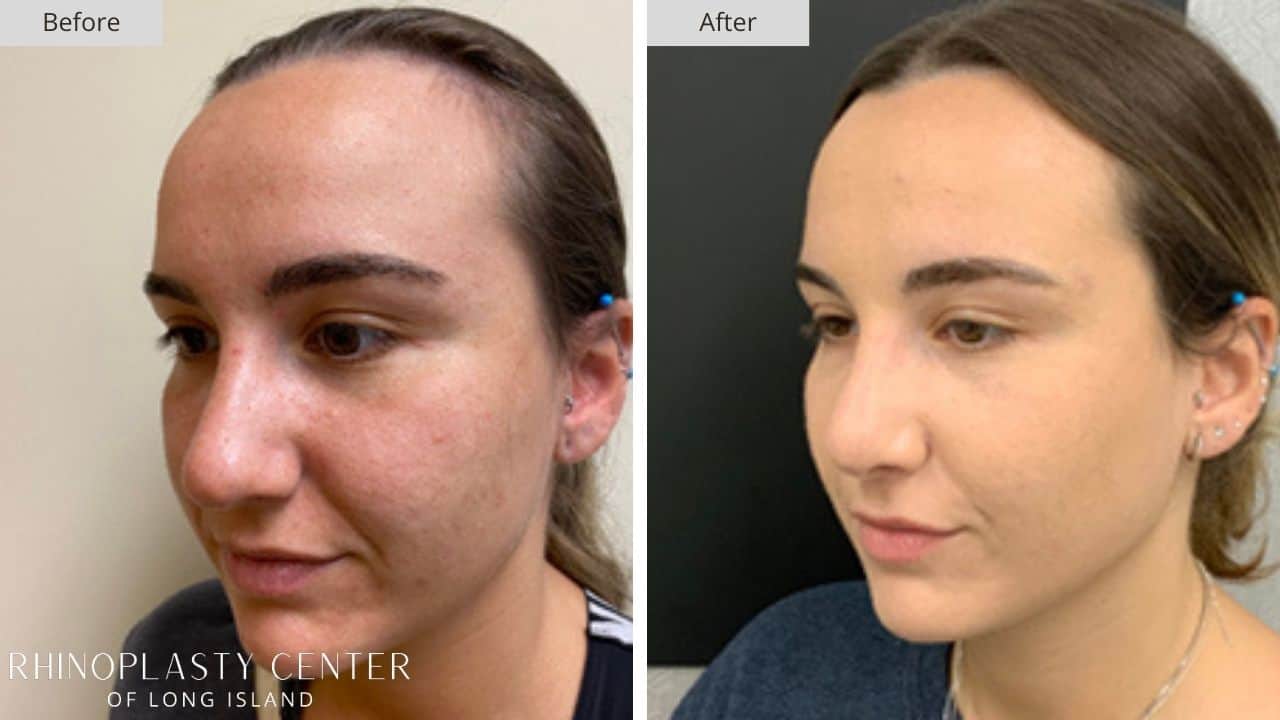 Rhinoplasty Long Island Before and After Photo 32a